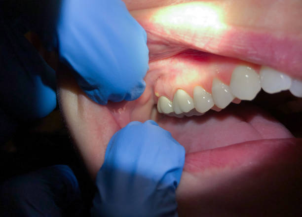 Best Broken or Cracked Tooth Emergency Dentist in Cartervle, IL